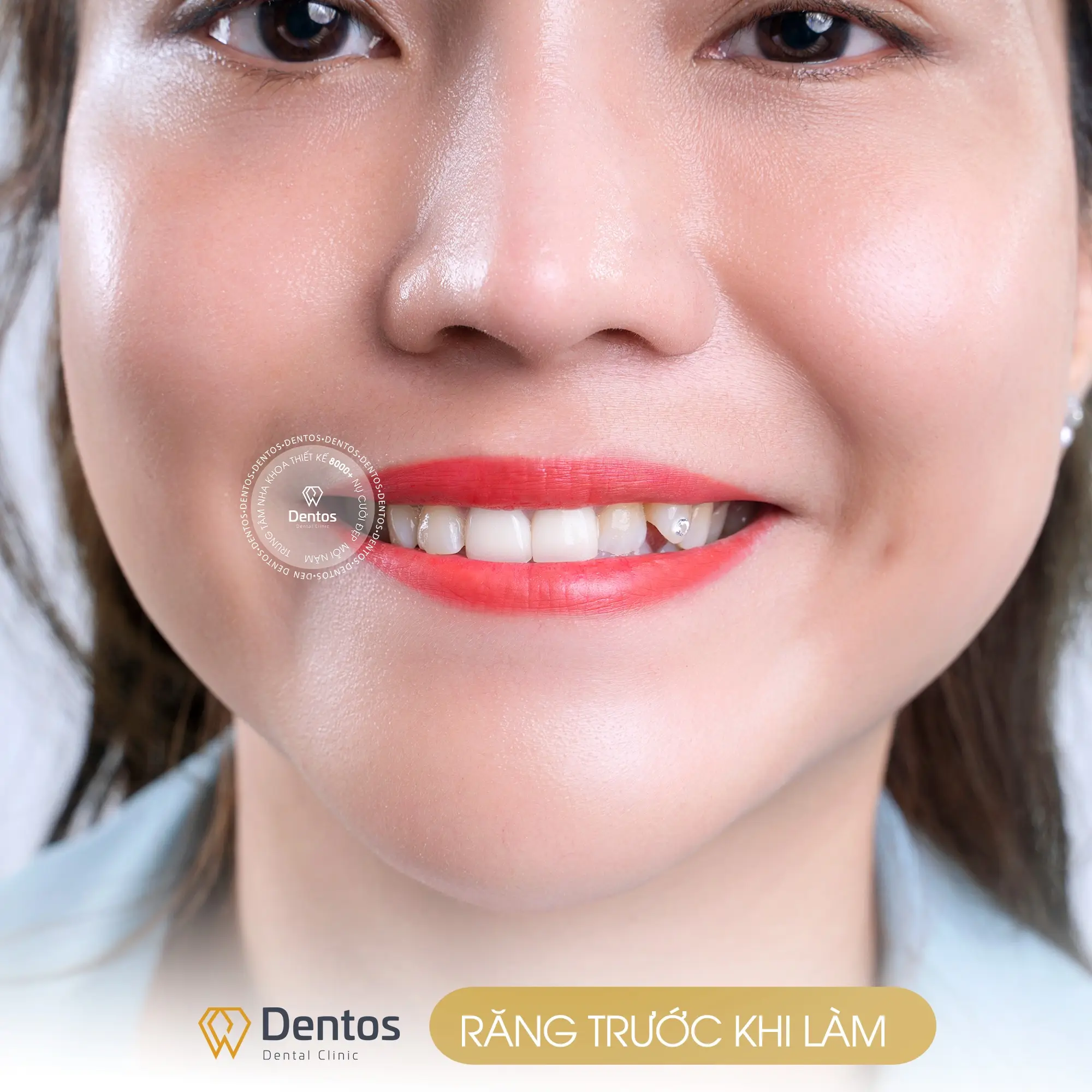 Bọc sứ hoàn toàn có thể giữ được dáng răng khểnh